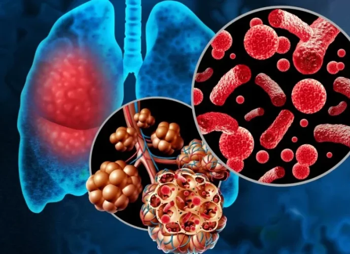 La neumonía es una infección que impacta principalmente los pulmones